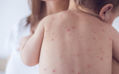 Sự khác nhau cơ bản nhất giữa bệnh sởi và phát ban do nhiệt