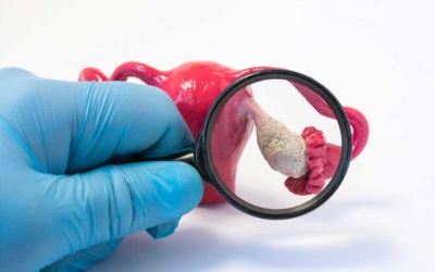 4 yếu tố làm tăng nguy cơ ung thư buồng trứng