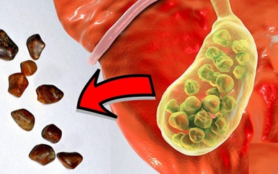 Muốn loại bỏ sỏi mật: Hãy thử một vài cách đơn giản sau!