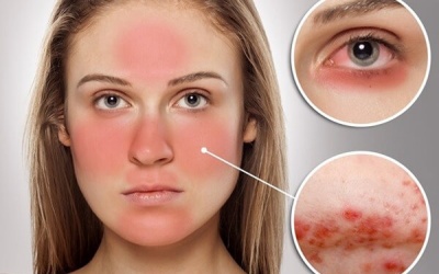 Các triệu chứng thường gặp của lupus ban đỏ