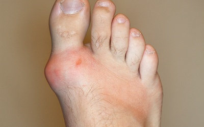 Làm sao để phòng bệnh gout tái phát trong dịp nghỉ Tết?