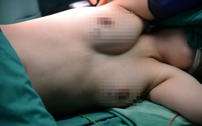 Tự khám ngực khi tắm, cô gái 25 tuổi phát hiện u xơ tuyến vú