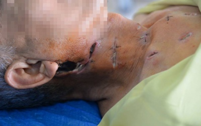 Tự ý chữa đái tháo đường, bệnh nhân loét nhiều phần trên cơ thể!