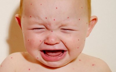 Những căn bệnh khiến trẻ bị phát ban