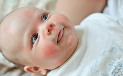 Vì sao trẻ bị nổi mề đay khi thời tiết thay đổi?