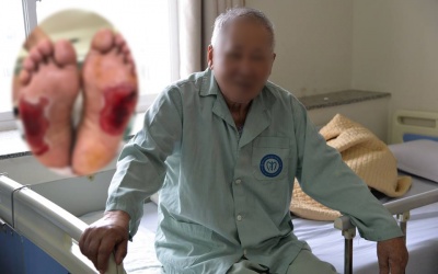 Cảnh báo: Bỏng nặng vì dùng đá chườm chữa đái tháo đường!