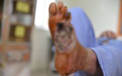 Gia tăng bệnh nhân đái tháo đường nhập viện vì biến chứng bàn chân