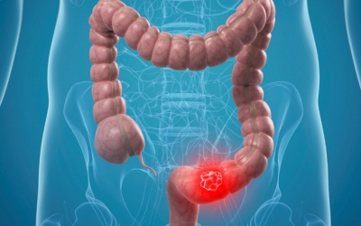 8 thói quen bạn nên thực hiện để giảm nguy cơ ung thư ruột kết
