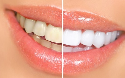Có nên sử dụng kem đánh răng làm trắng không? 