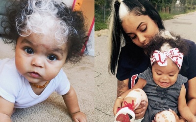 Trẻ nhỏ bị bạc tóc có phải do thiếu vitamin? 