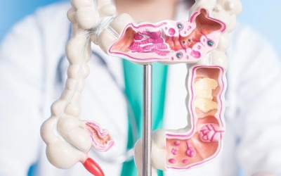 4 yếu tố làm tăng nguy cơ ung thư đại trực tràng