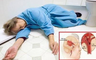 Các yếu tố nguy cơ gây đột quỵ ở phụ nữ