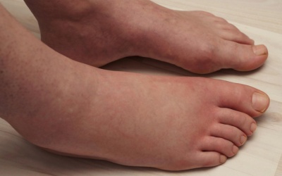 5 nguyên nhân khiến bàn chân bị sưng