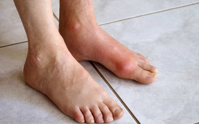 Những căn bệnh dễ nhầm với bệnh gout