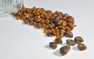 Người phụ nữ có hơn 2.000 viên sỏi mật do lối sống thiếu lành mạnh