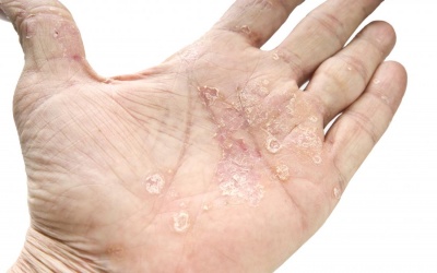 10 dấu hiệu cảnh báo bệnh vẩy nến thường gặp