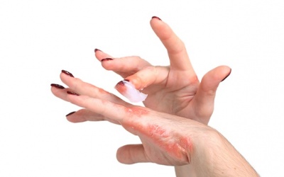 Cách giảm eczema trên bàn tay