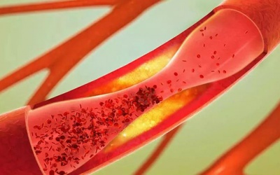 6 dấu hiệu cảnh báo bệnh mạch vành bạn nên cảnh giác