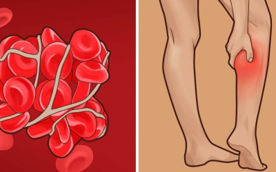 7 dấu hiệu thầm lặng cảnh báo cục máu đông