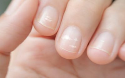 Có đốm trắng trên móng tay của trẻ có nên lo lắng?