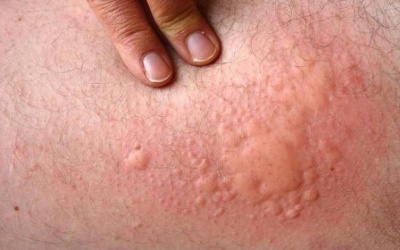 Những nguyên nhân khiến bạn bị nổi mề đay mạn tính