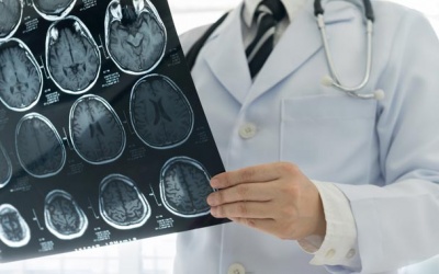 Làm thế nào để phân biệt đột quỵ và phình mạch máu não?