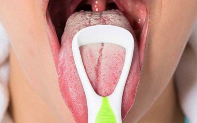 Lưỡi có nhiều vết nứt do đâu?