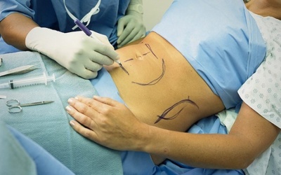 BV Bạch Mai thông tin về việc cô gái trẻ tử vong do hút mỡ bụng