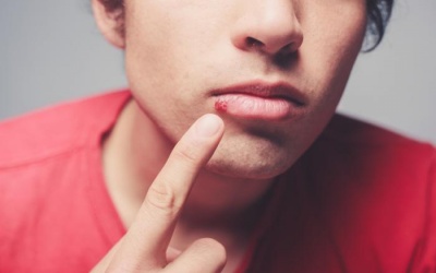 Vết loét lạnh và mụn rộp có giống nhau không? 