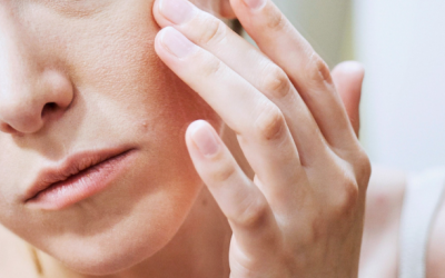 Dùng Azacné có giúp giảm mụn đỏ, ngứa rát?