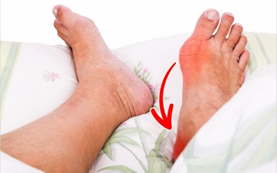 Nguyên nhân nào khiến bạn bị gót chân đau vào buổi sáng? 