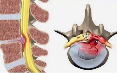 Người bị thoái hóa đĩa đệm nên ăn gì để nhanh khỏi bệnh?