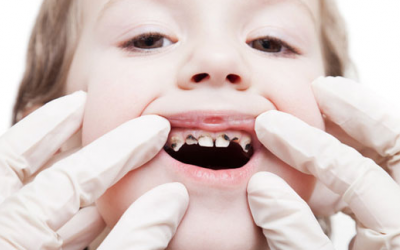 Phòng ngừa và điều trị sâu răng ở trẻ có khó khăn?