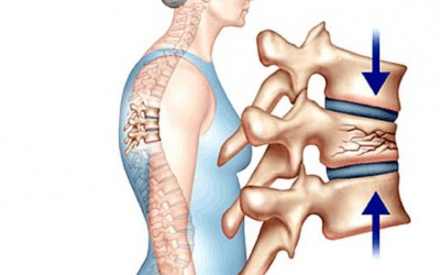 Lời khuyên về chế độ dinh dưỡng cho người bị loãng xương