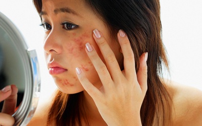 Phát hiện phương pháp mới có thể kiềm dầu, trị mụn trứng cá