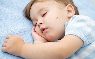 Trẻ bị sưng to ở vết muỗi đốt do đâu? 