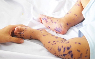 Trẻ bị tay chân miệng dùng xanh methylen có ảnh hưởng gì không?