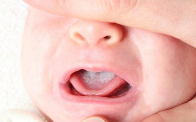 Trẻ nấm miệng có nên dùng thuốc bôi dartarin?