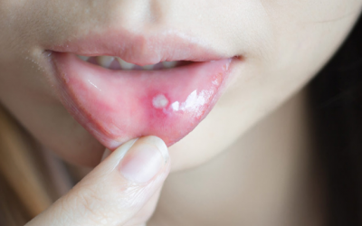 Nhiệt miệng, loét miệng do đâu, chữa thế nào?