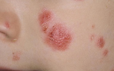 5 biện pháp tự nhiên giúp cải thiện bệnh vảy nến