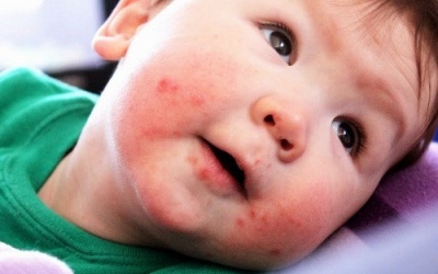 Nổi mụn nước quanh miệng có phải mắc tay chân miệng không?