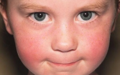 Nhận biết lupus ban đỏ qua ban cánh bướm