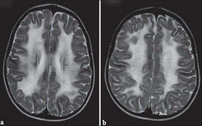 Hút thuốc lá làm tăng nguy cơ thoái hóa chất trắng ở não
