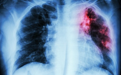 Trung Quốc tìm ra 'chìa khóa' để điều trị bệnh ung thư phổi