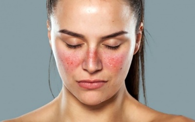 8 biện pháp tự nhiên giúp kiểm soát bệnh lupus