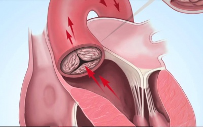 Hở van động mạch chủ 2/4 đã phải điều trị chưa?
