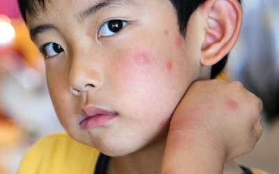 3 bước đơn giản giúp điều trị vết côn trùng cắn ở trẻ 