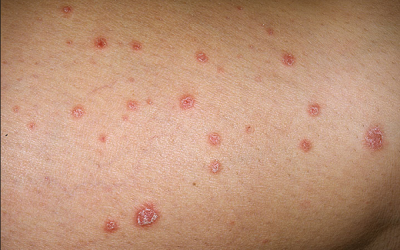 Những biện pháp đơn giản giúp kiểm soát bệnh vẩy nến