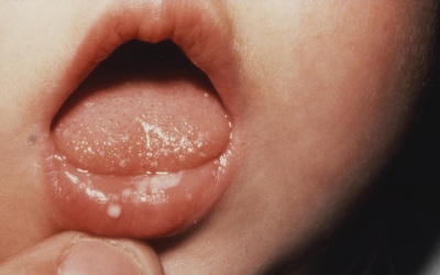 Trẻ bị đốm trắng trong miệng và lưỡi do đâu? 