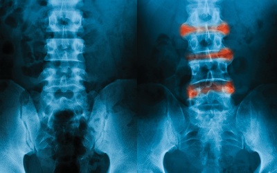 Viêm cột sống dính khớp là bệnh gì, ảnh hưởng thế nào?